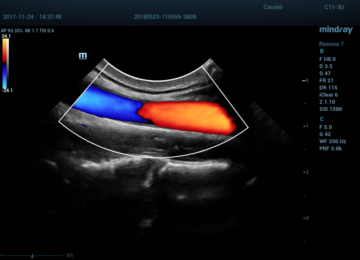 Сонная артерия в цвете