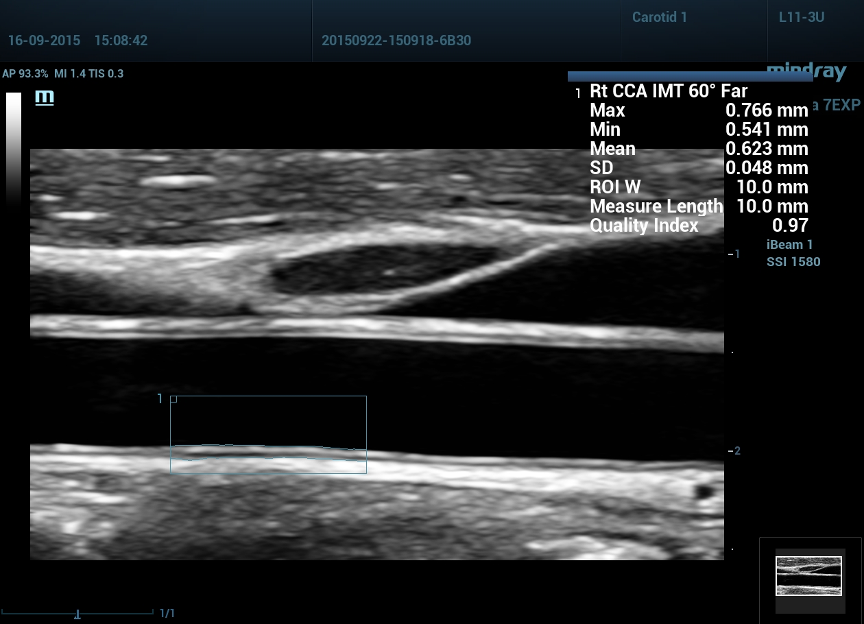 Сонная артерия IMT