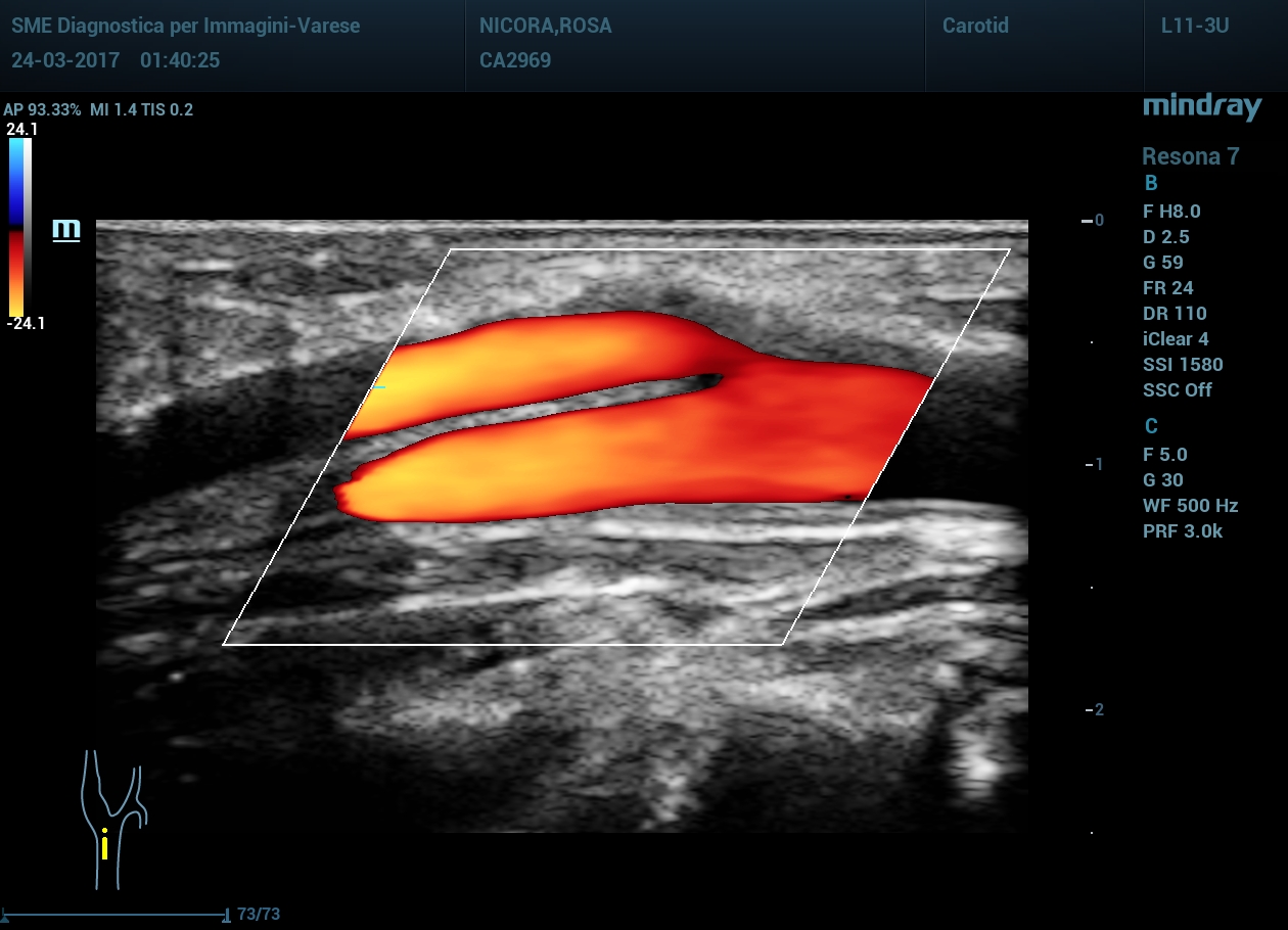 Сонная артерия в цвете