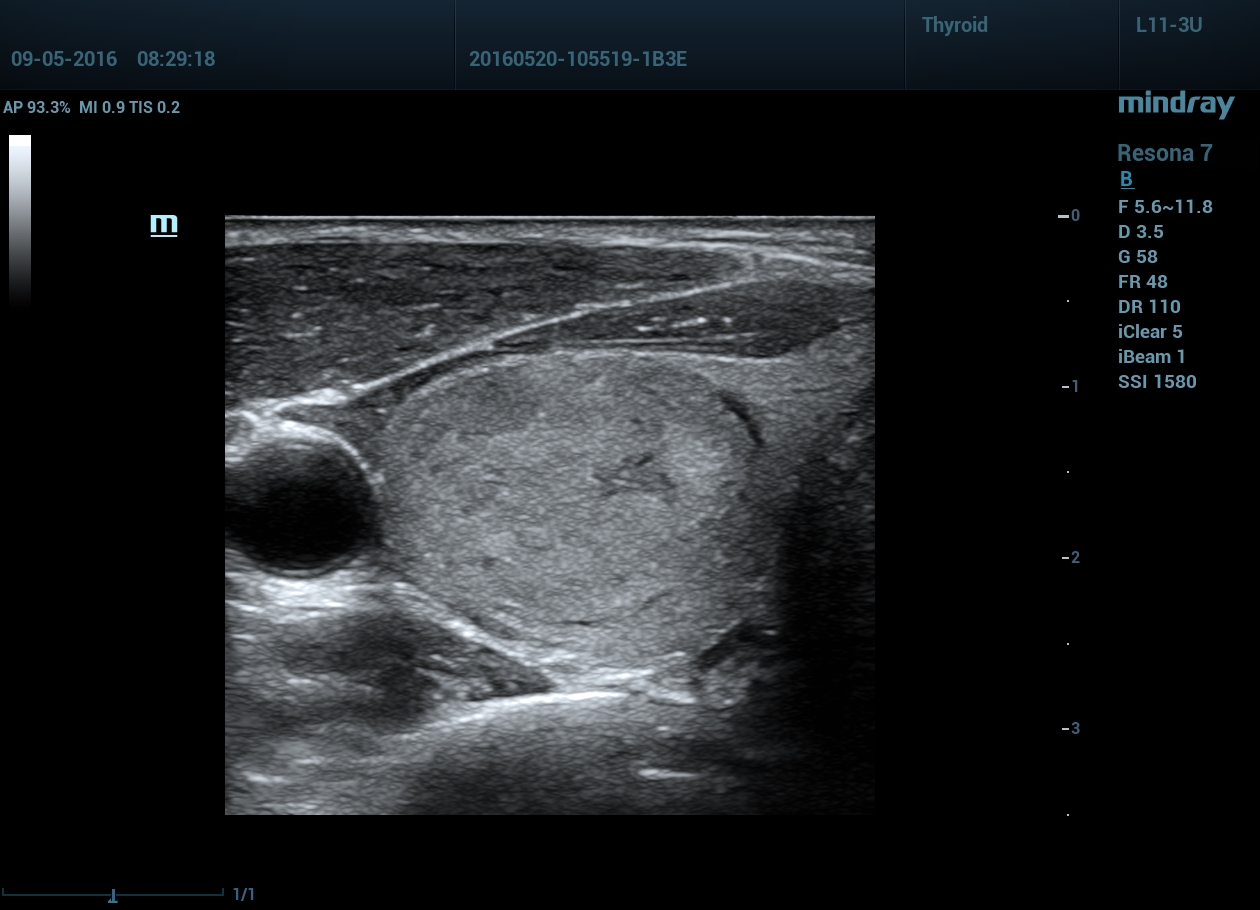Щитовидная железа, масса, В