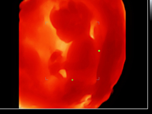 14-недельный эмбрион в режиме iLive