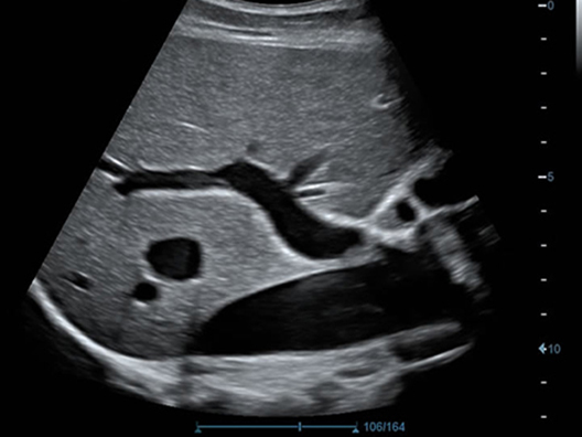 Печень, 2D (PV IVC)