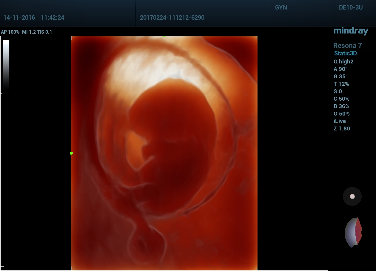 Плод на ранних сроках