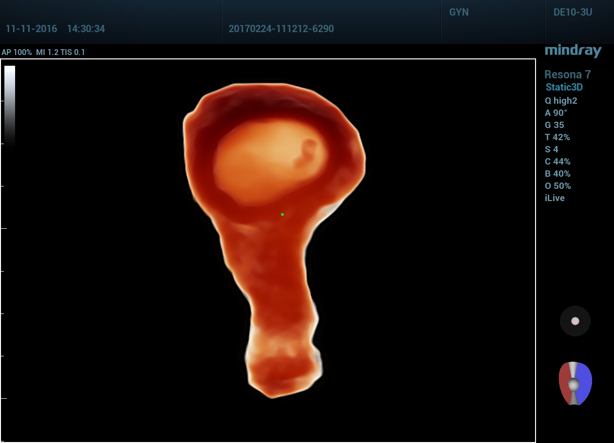 Плод на ранних сроках