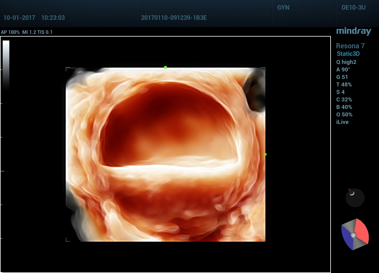 Шоколадная киста яичника