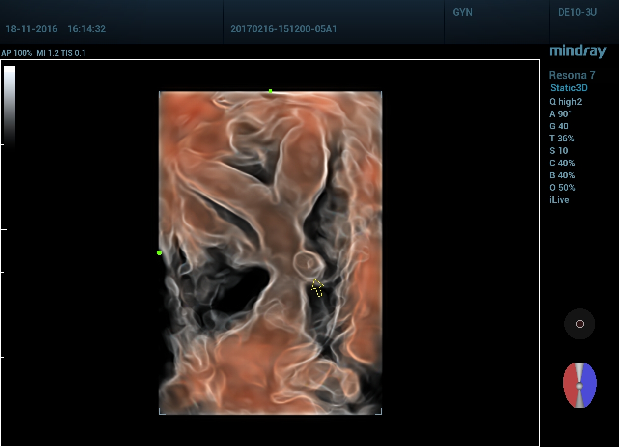 Матка 3D гиалиновая зона