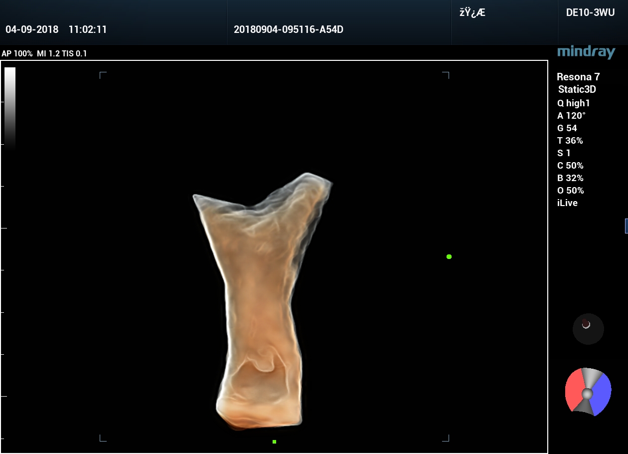 Седловидная матка, дивертикул матки, полипы эндометрия
