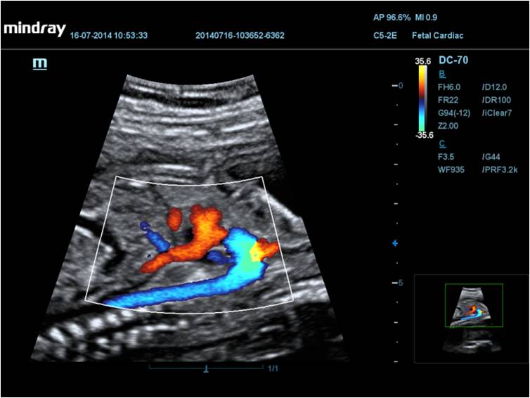 Fetal Aorta Color