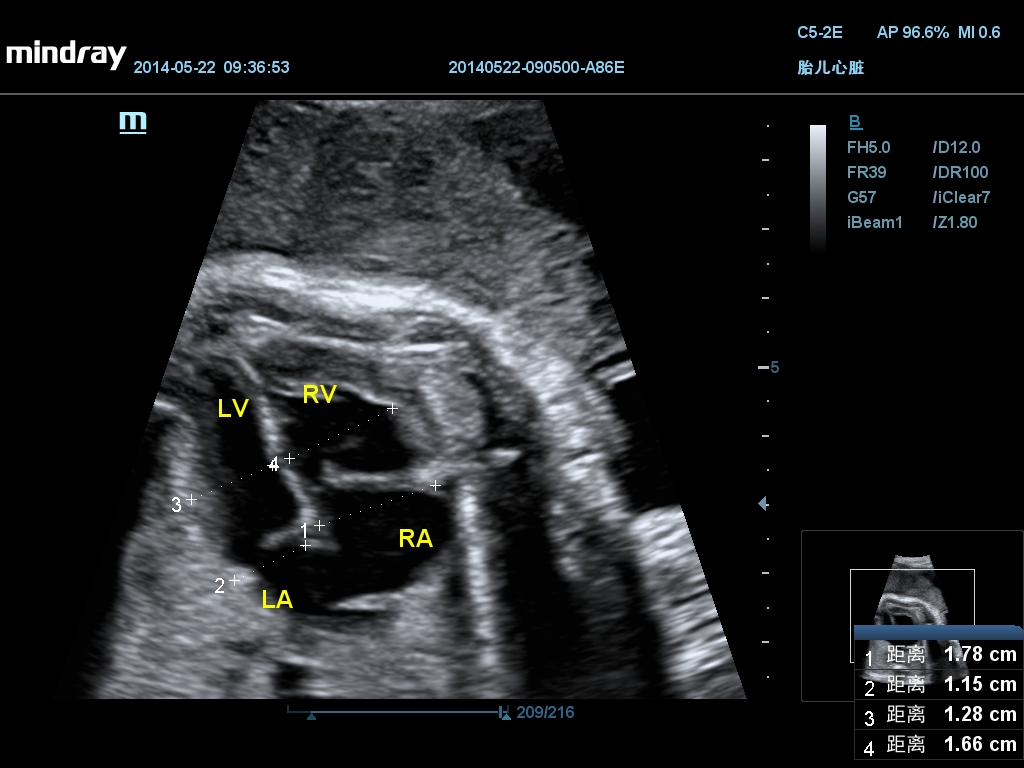 Fetal Heart 2D