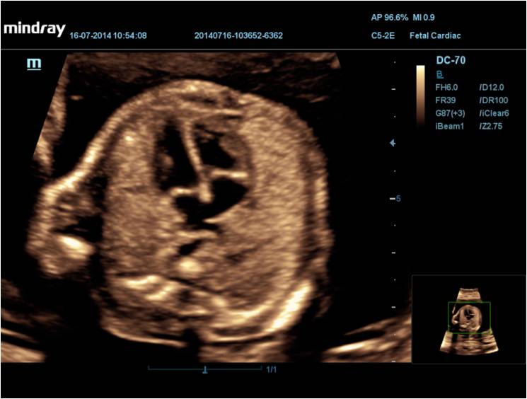 Fetal Heart 2D