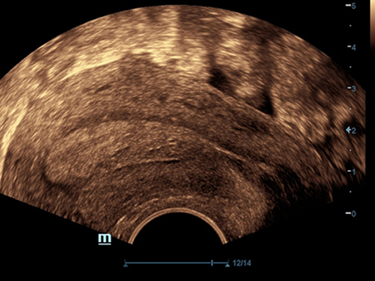Изображение внутривагинального