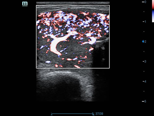 Гипертиреоз, цветовое представление в высоком разрешении