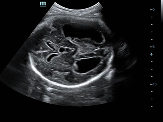 Гидроцефалия