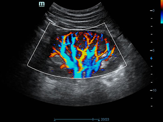 Перфузия почки с кровотоком в высоком разрешении