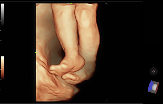Fetal Leg 3D