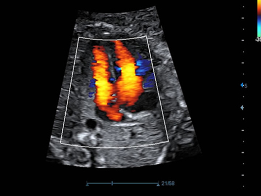 Сброс крови через овальное окно