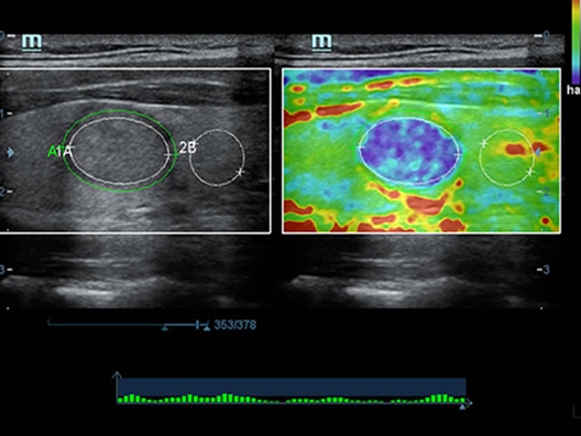 Эластография узлового зоба с уникальным анализом зоны