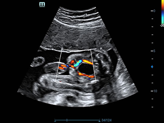 Пупочные артерии