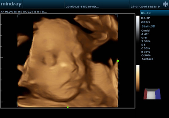 Ультразвуковой аппарат DC-30