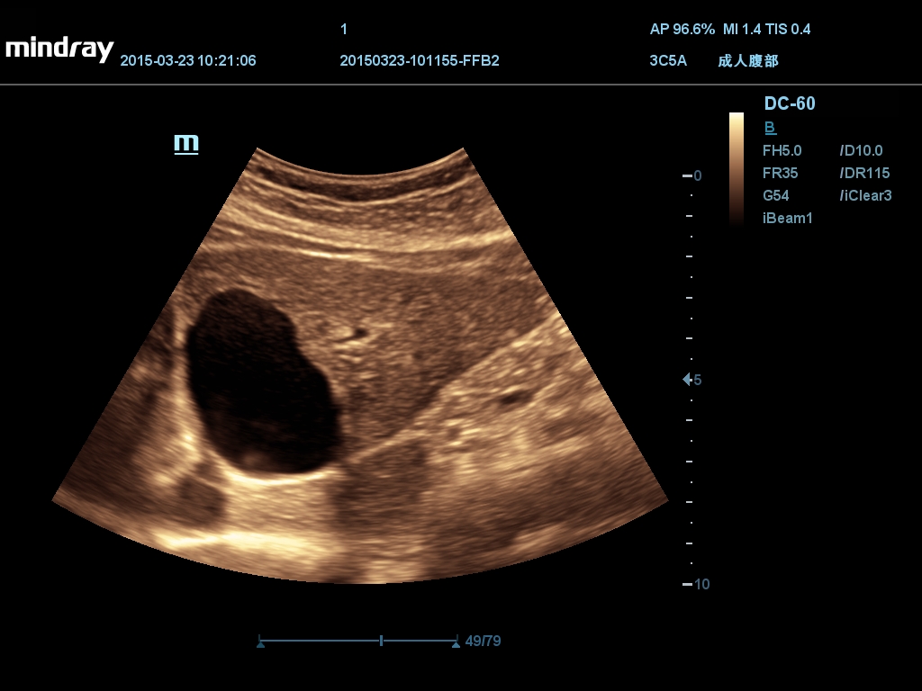 Киста левой доли печени