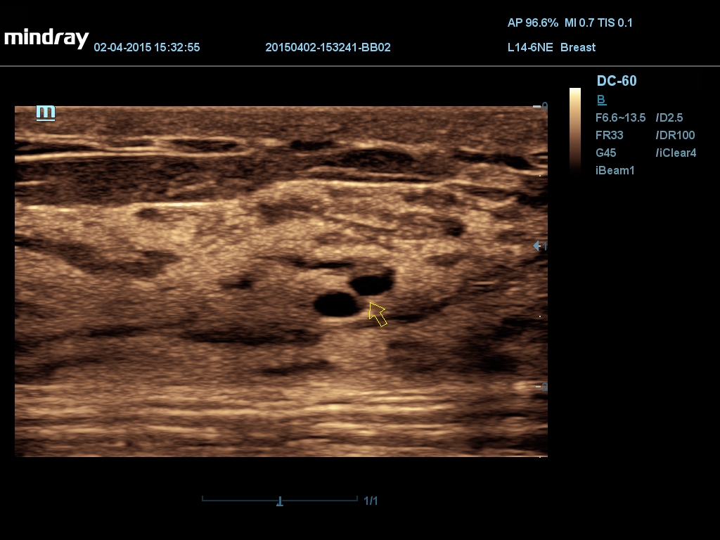 овышение эхогенности ткани молочной железы, расширение протоков