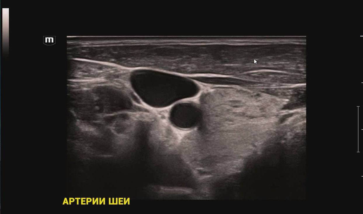 Артерии шеи