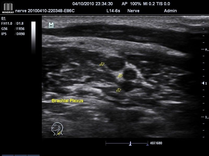Плечевое сплетение