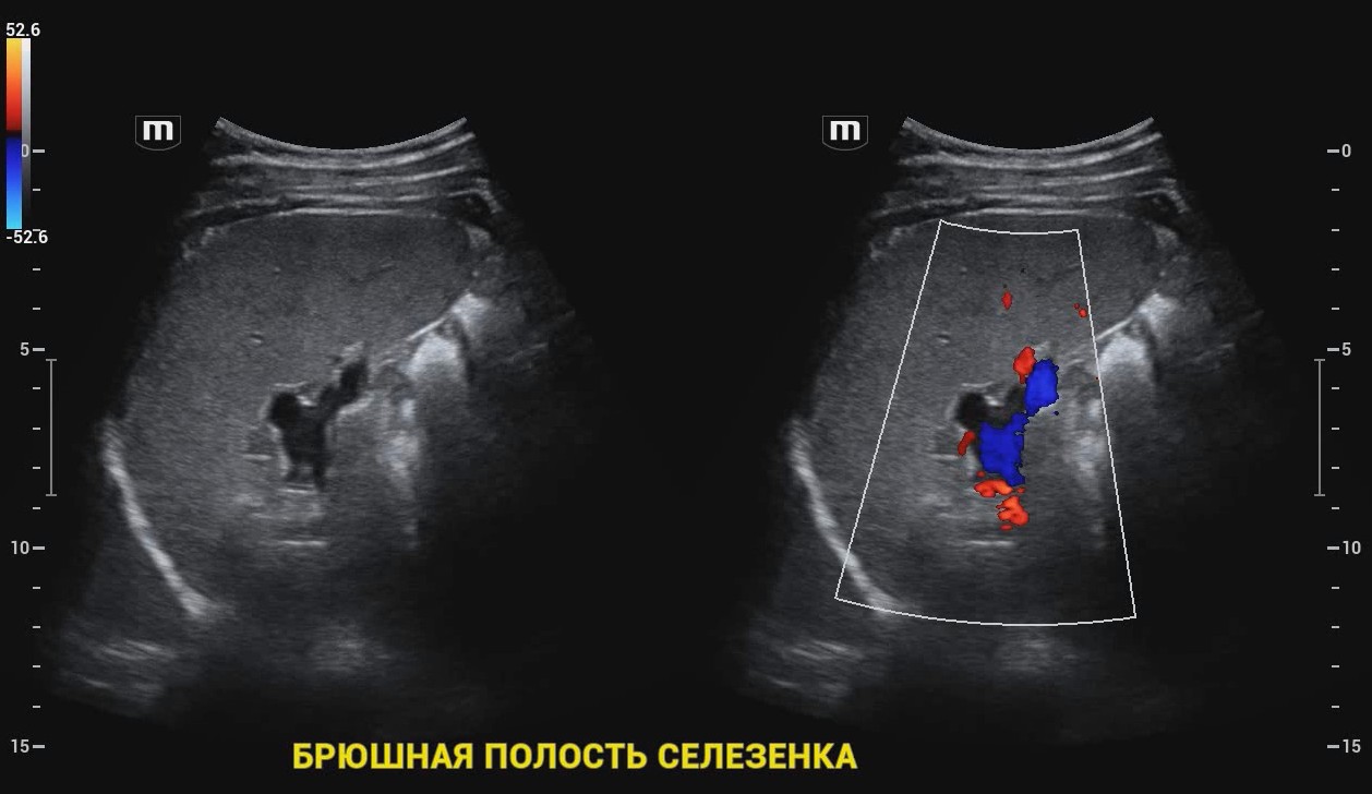 Брюшная полость селезенка