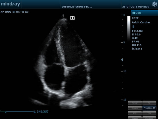 Четырехкамерный срез сердца