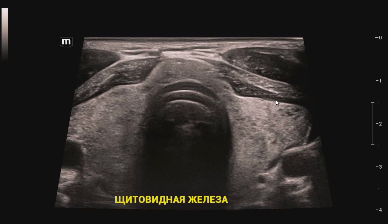 Щитовидная железа