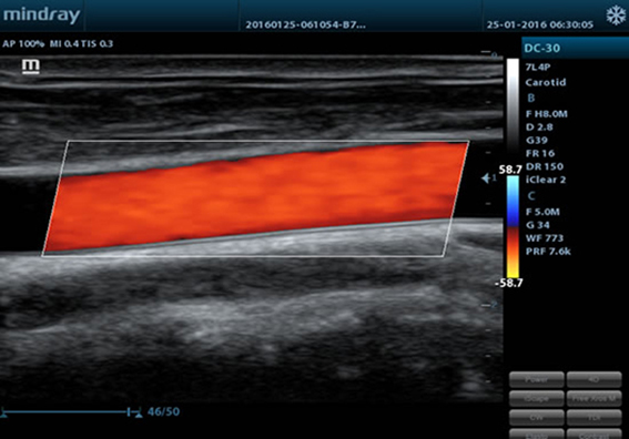 Цветовое представление кровотока сонной артерии