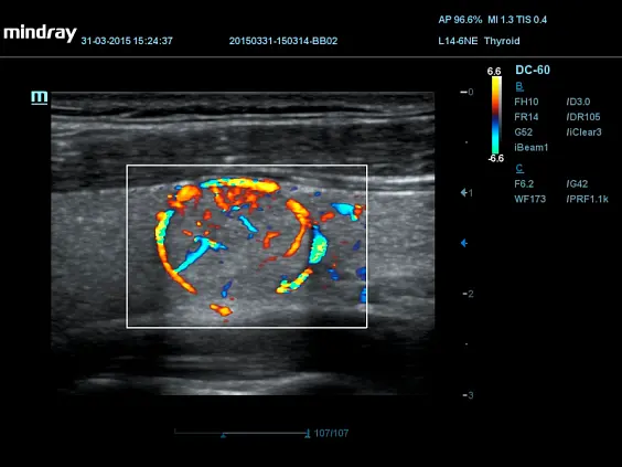 Аденома щитовидной железы в режиме HP Flow