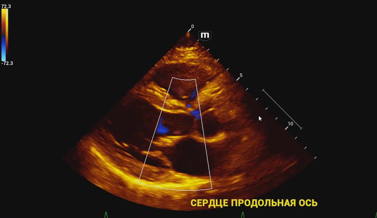 Сердце продольная ось