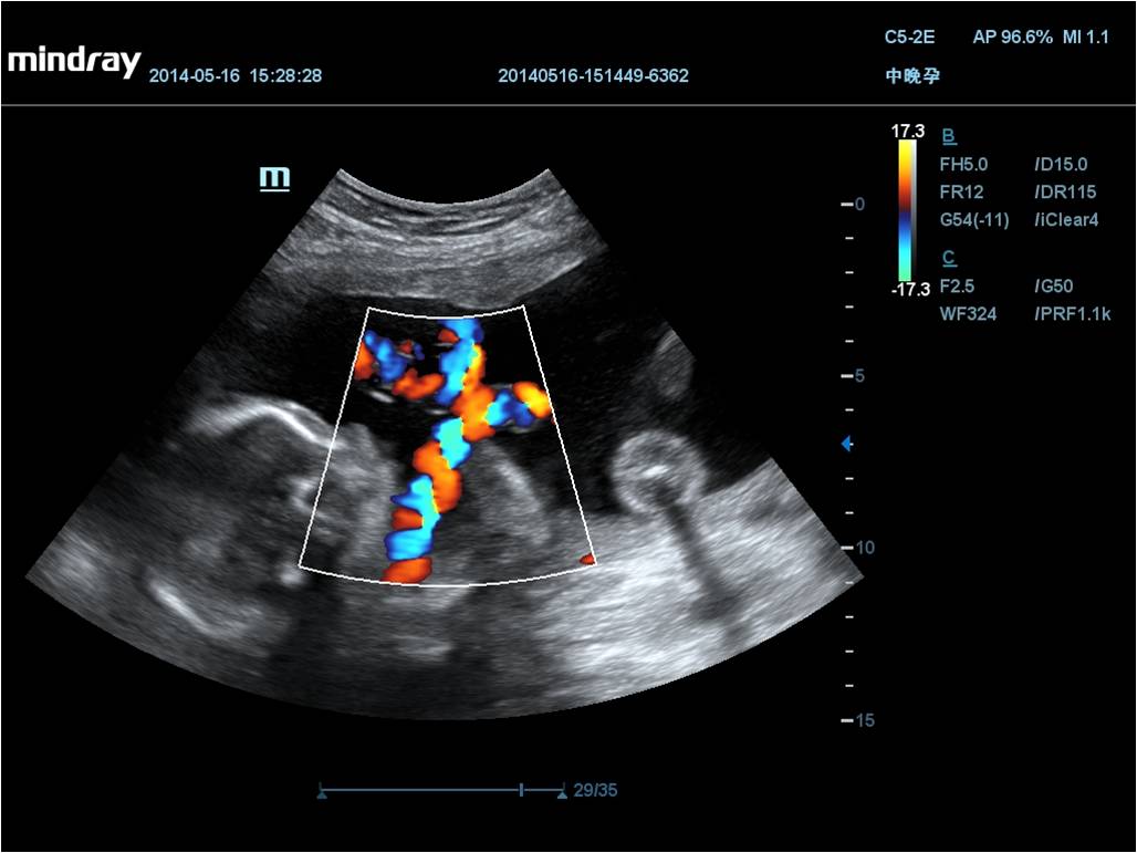 Fetal Umbilical Cord Color