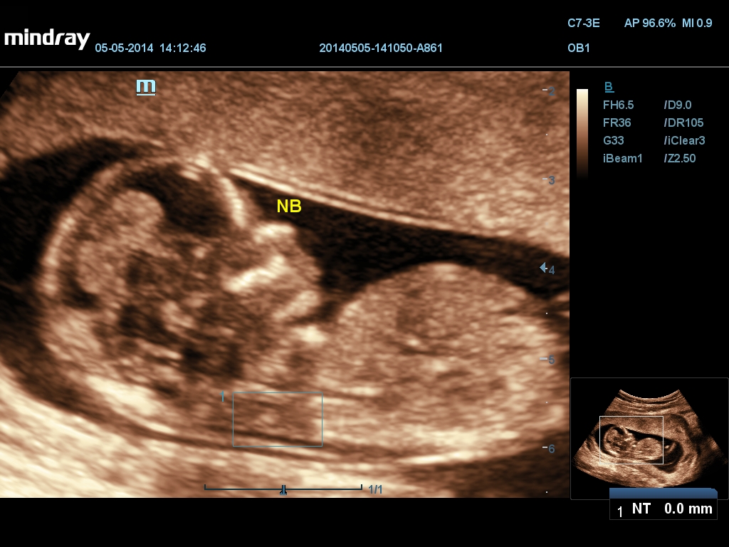 Fetal NT 2D