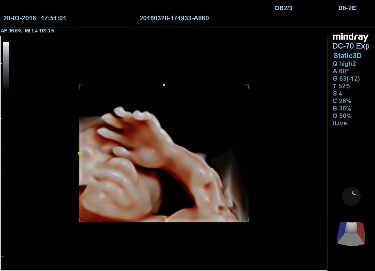 Fetal Fingers 3D iLive