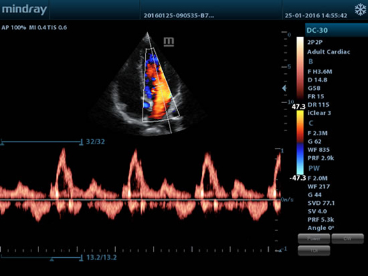 Пульсовая волна четырехкамерного среза