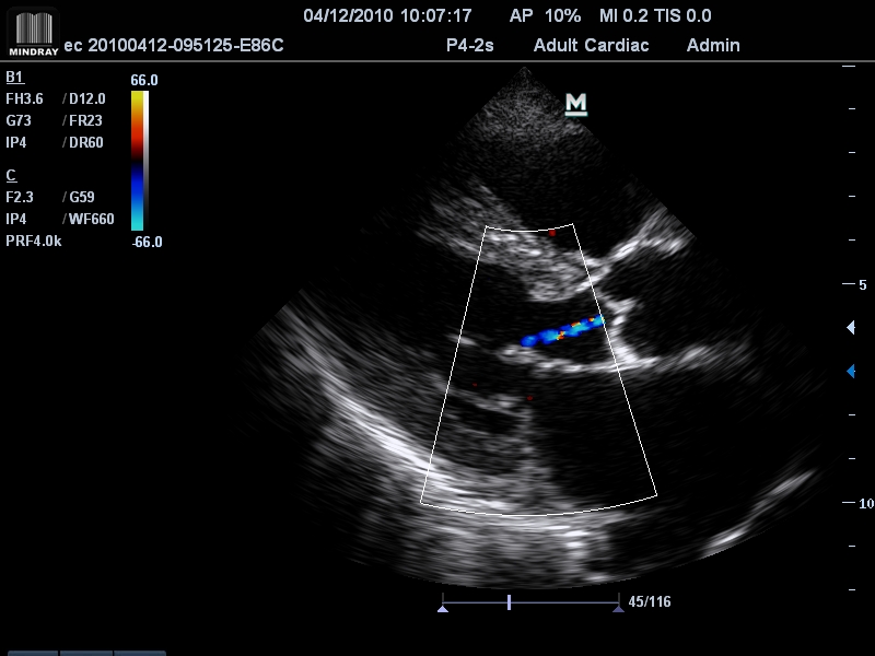 Аортальная регургитация