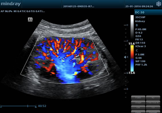 Цветовое представление кровотока почки