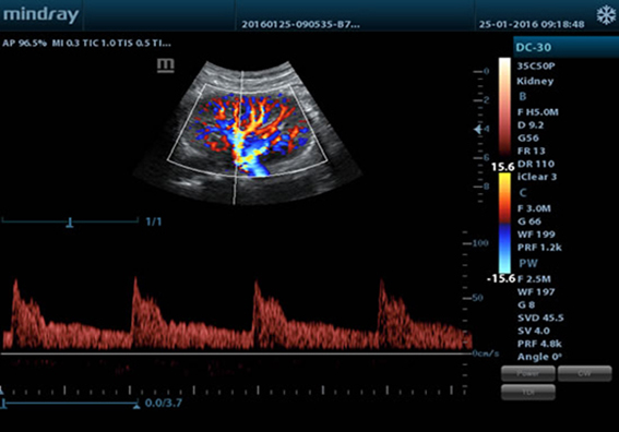 Пульсовая волна почки
