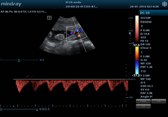 Пульсовая волна пупочной артерии