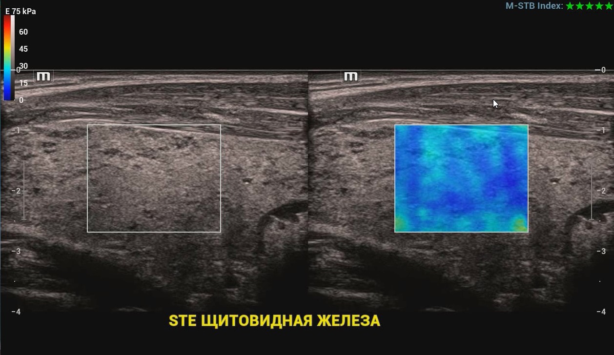 STE Щитовидная железа