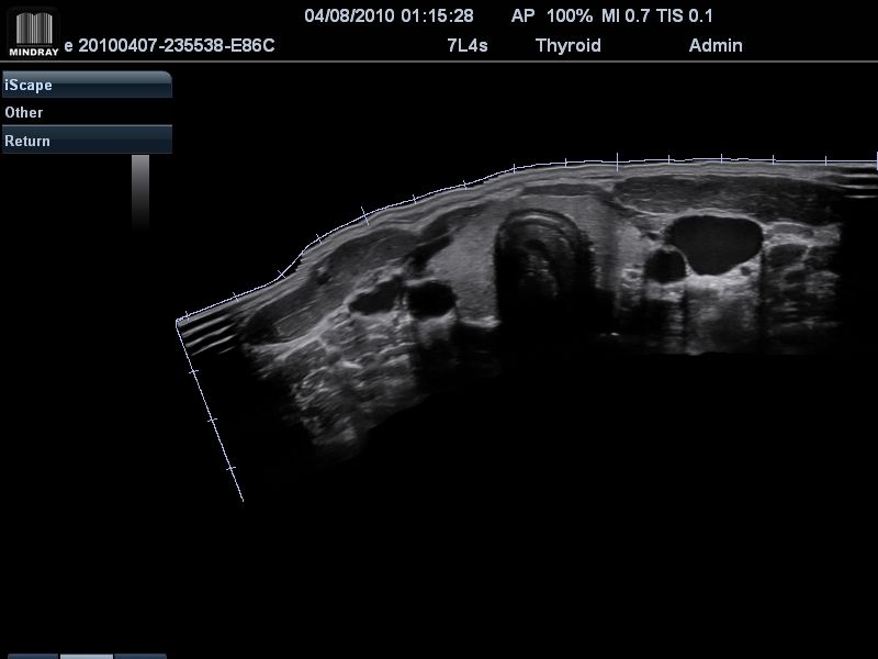 Щитовидная железа